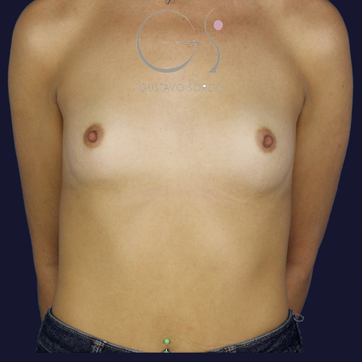 Aumento de pecho con prótesis anatómicas de 375 cc para ganar volumen con resultado natural: antes, vista frontal