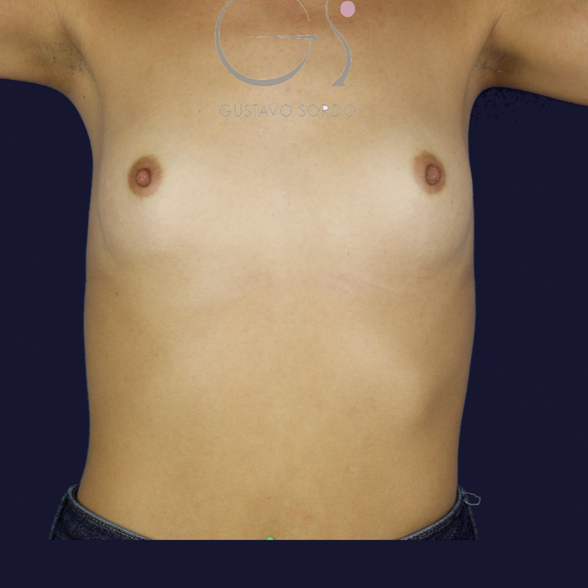 Aumento de pecho con prótesis anatómicas de 375 cc para ganar volumen con resultado natural: antes, vista frontal con los brazos arriba