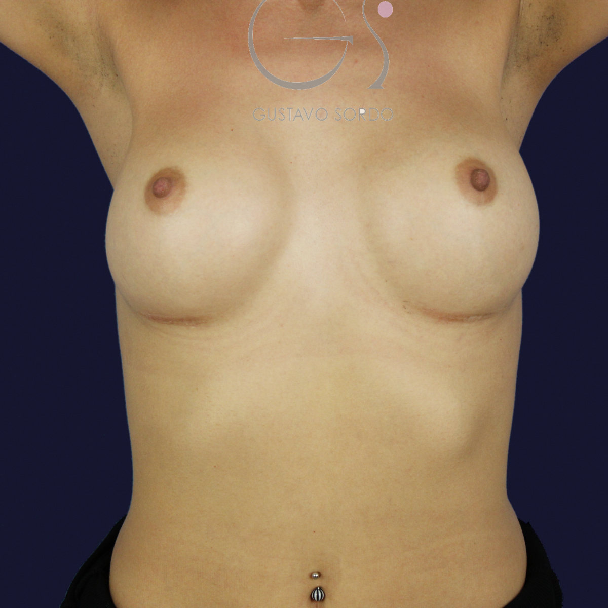 Aumento de pecho con prótesis anatómicas de 375 cc para ganar volumen con resultado natural: después, vista frontal con los brazos arriba