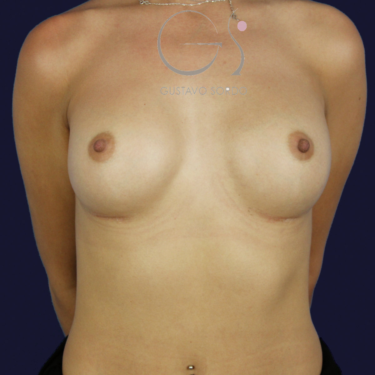 Aumento de pecho con prótesis anatómicas de 375 cc para ganar volumen con resultado natural: después, vista frontal