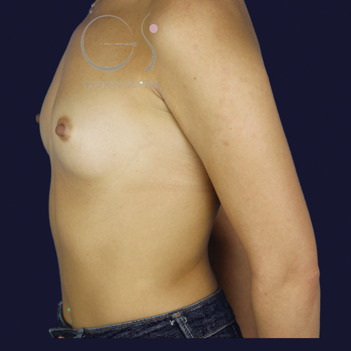 Aumento de pecho con prótesis anatómicas de 375 cc para ganar volumen con resultado natural: antes, perfil derecho
