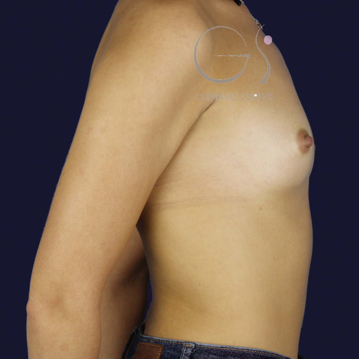Aumento de pecho con prótesis anatómicas de 375 cc para ganar volumen con resultado natural: antes, perfil izquierdo