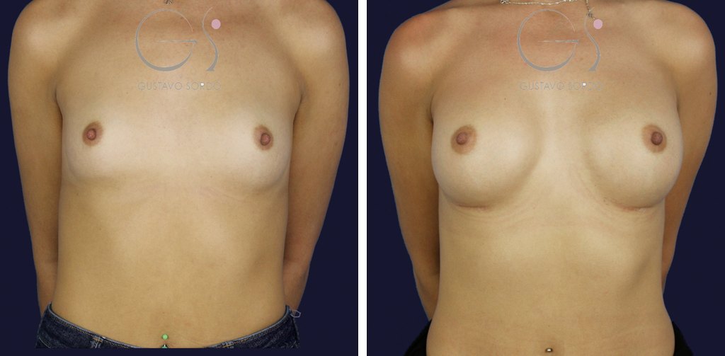 Antes y después de un aumento de pecho con prótesis anatómicas de 375 cc para ganar volumen con resultado natural, caso operado por el Dr. Gustavo Sordo en Madrid