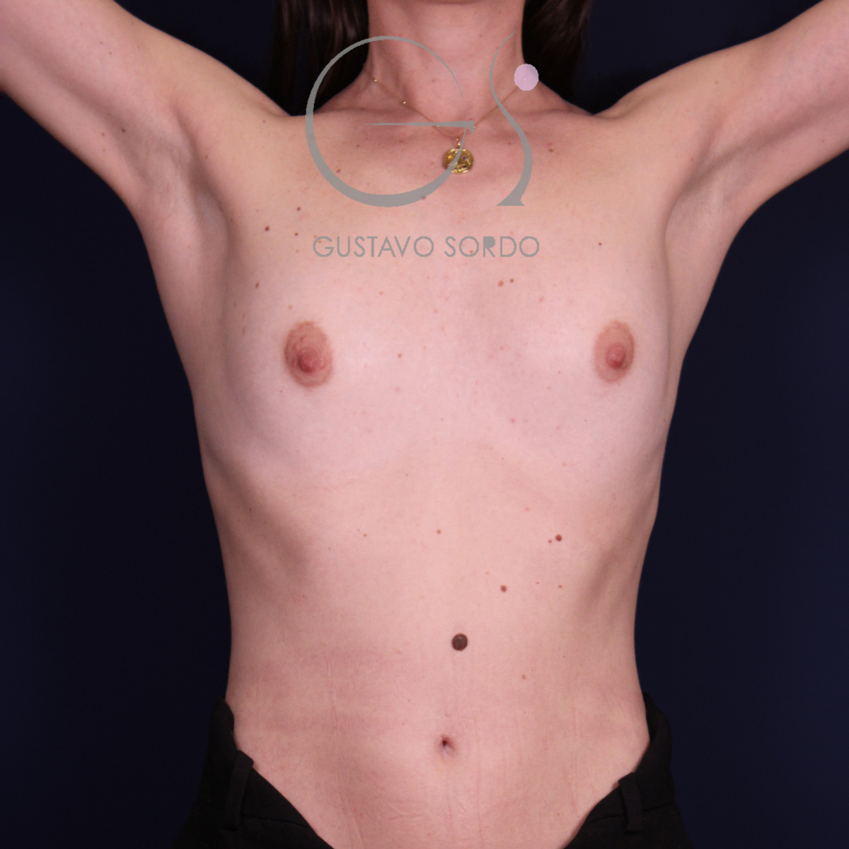Aumento de pecho con implantes anatómicos de 320 cc: antes, vista frontal con los brazos arriba