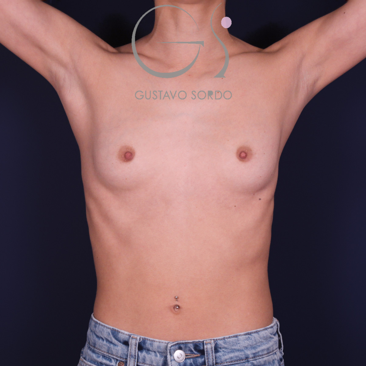 Aumento de pecho con implantes redondos de 250 cc en mamas asimétricas: antes, vista frontal con los brazos arriba