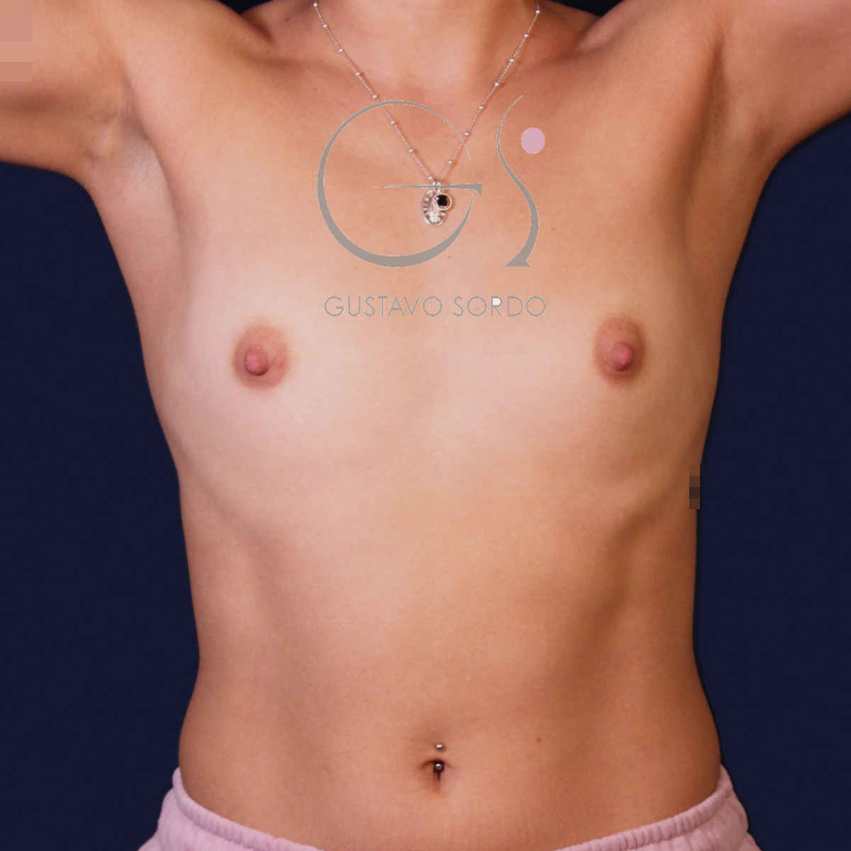 Aumento de pecho con implantes redondos de 250 cc: antes, vista frontal con los brazos arriba