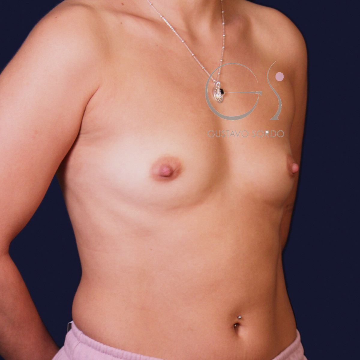 Aumento de pecho con implantes redondos de 250 cc: antes, oblicua izquierda