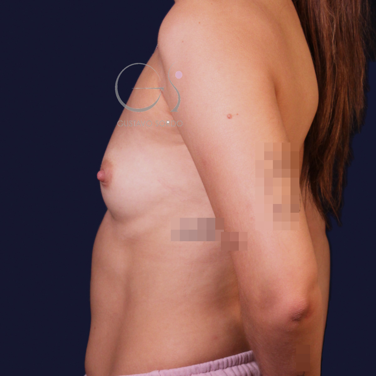 Aumento de pecho con implantes redondos de 250 cc: antes, perfil derecho