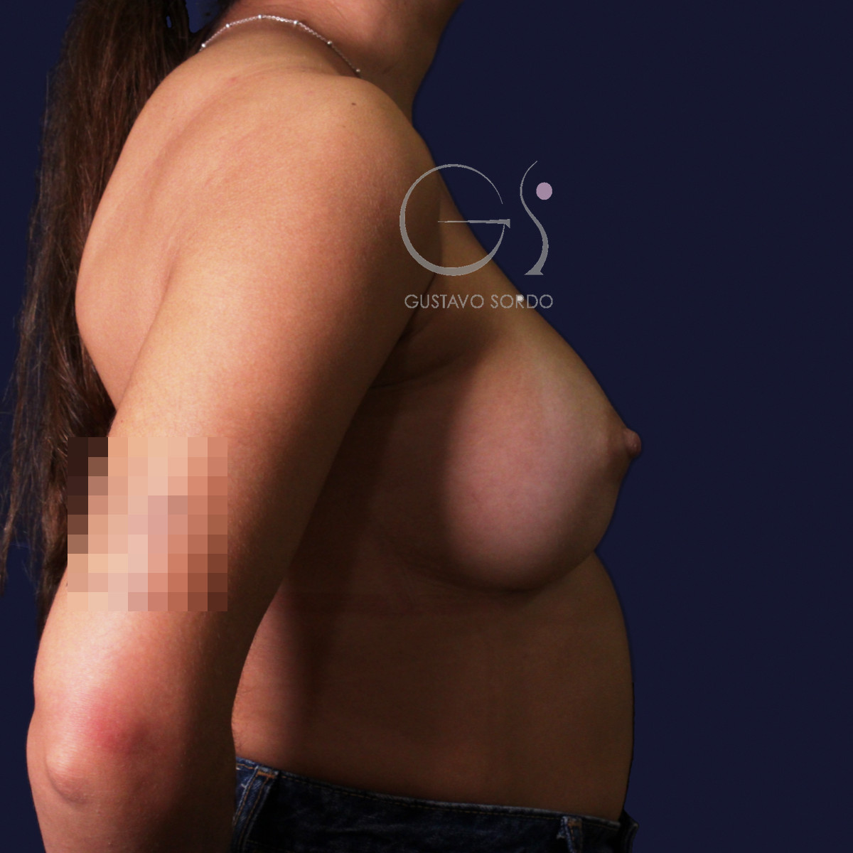 Aumento de pecho con implantes redondos de 250 cc: después, perfil izquierdo