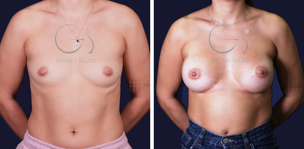 Breast augmentation with 250cc round implants: before and after