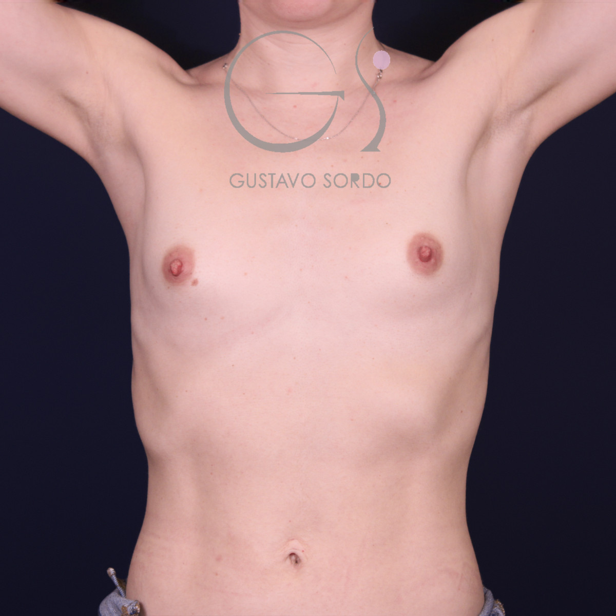 Aumento de pecho con implantes redondos de 375 cc en pecho muy pequeño: antes, vista frontal con los brazos arriba