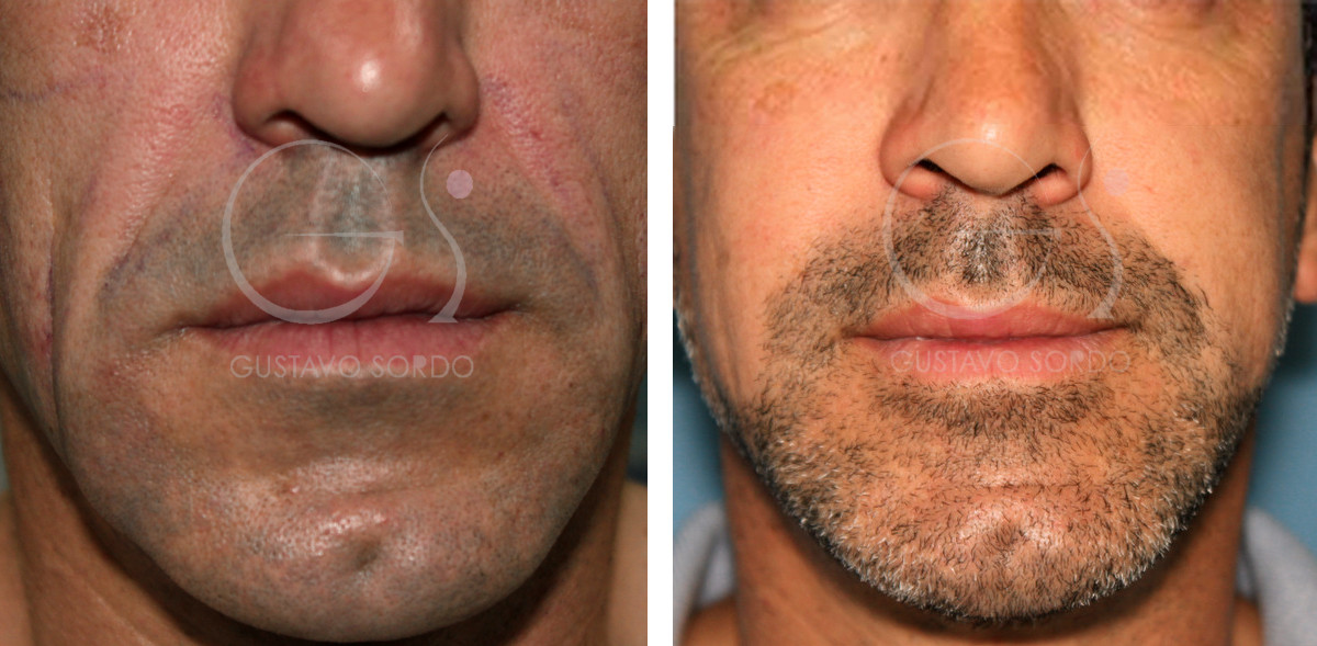 Lipotransferencia de grasa — en hombre: antes y después de un caso operado en Madrid