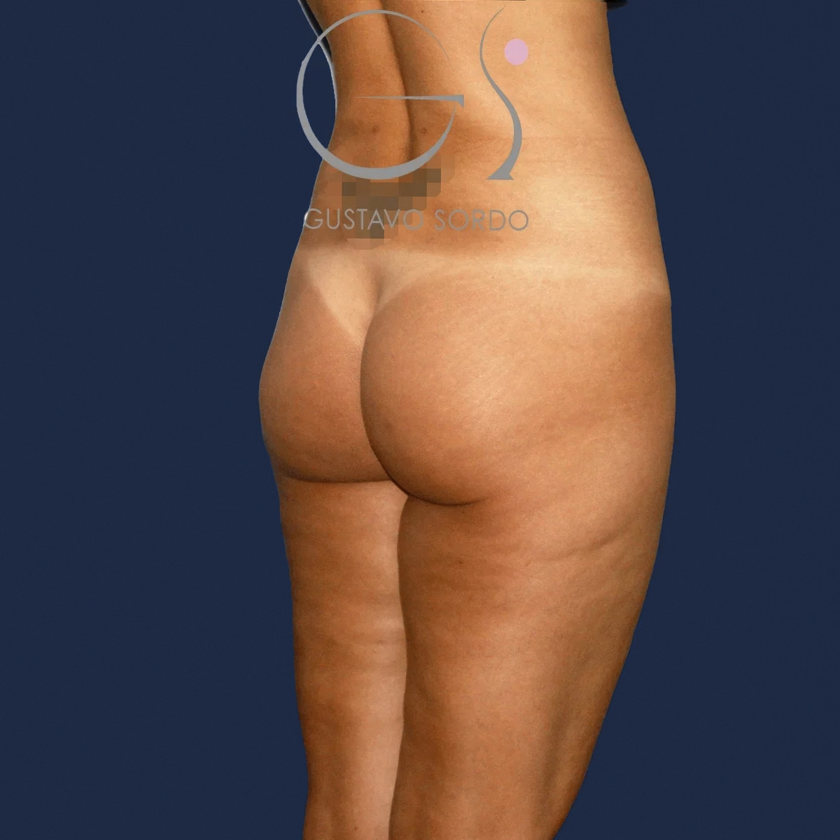 Lipotransferencia de grasa: antes y después de un caso operado en Madrid