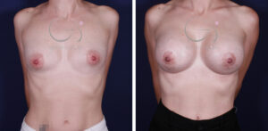 Mamas tuberosas con mastopexia periareolar y anatómicas de 295 cc