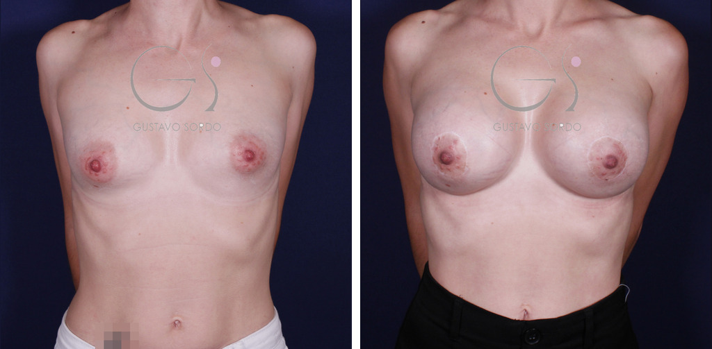 Mamas tuberosas con mastopexia periareolar y anatómicas de 295 cc: antes y después