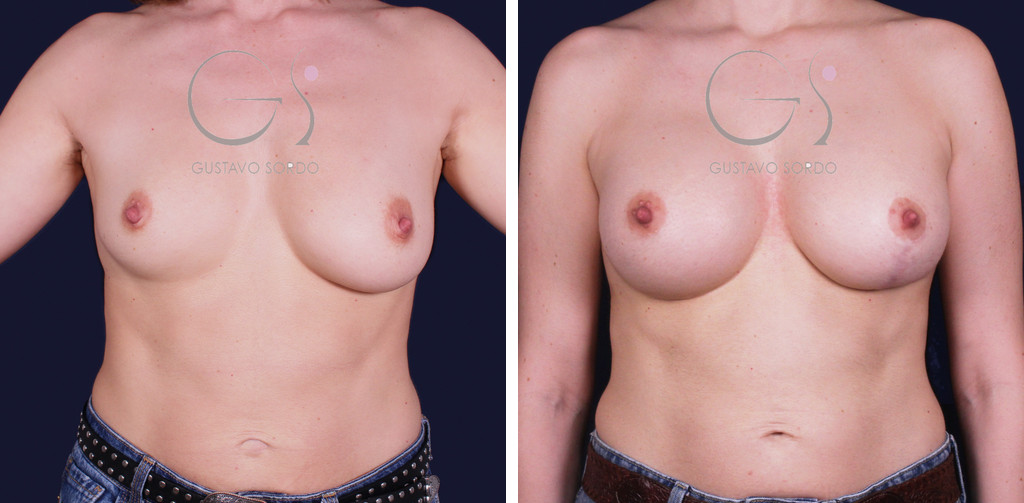 Unilateral mastopexy and augmentation with 250 and 350 cc round implants: before and after