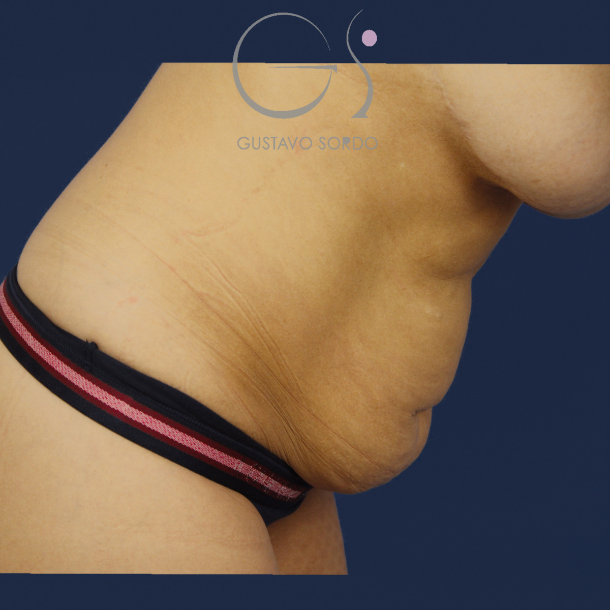 Mujer mommy makeover: antes, perfil izquierdo