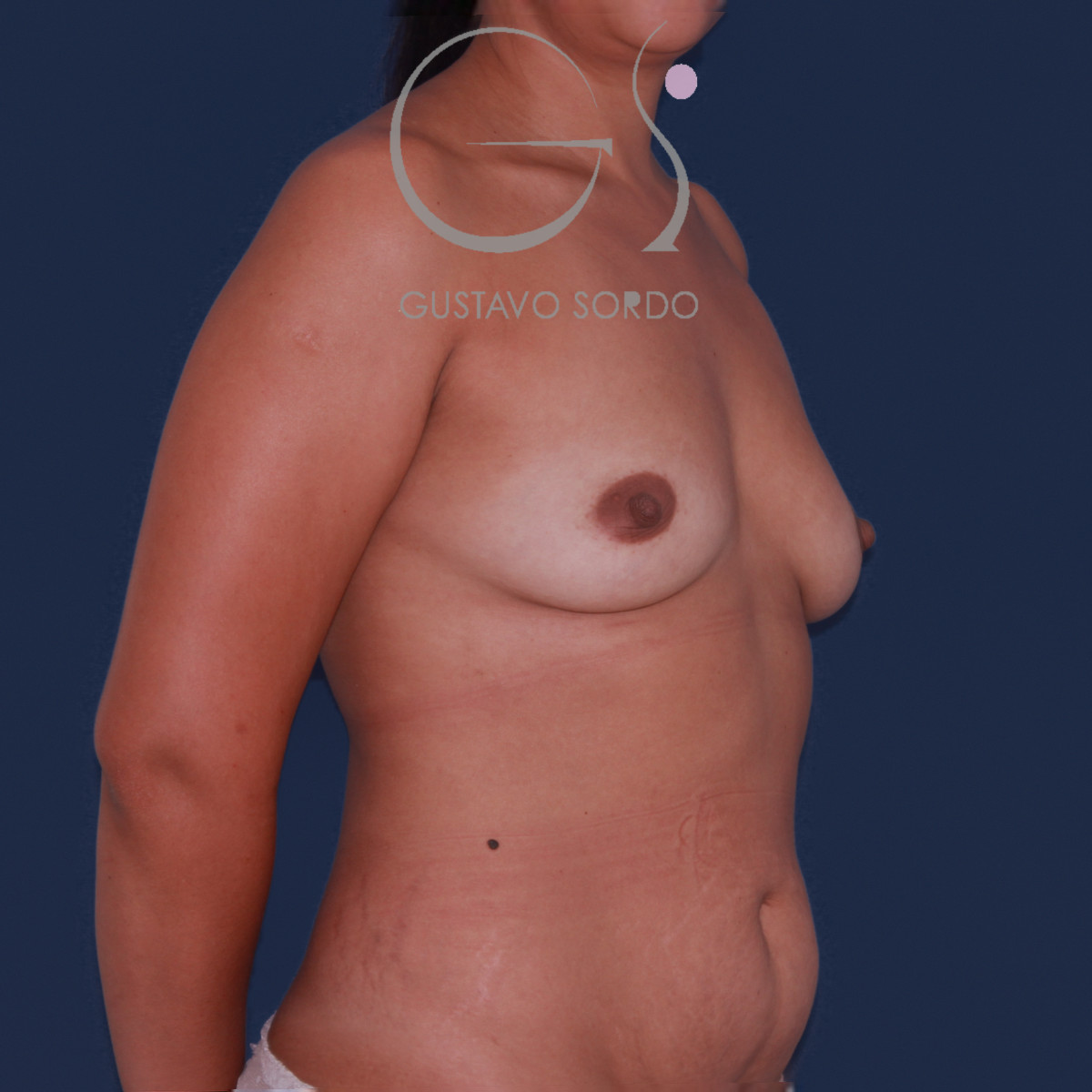 Mujer mommy makeover: antes, oblicua izquierda