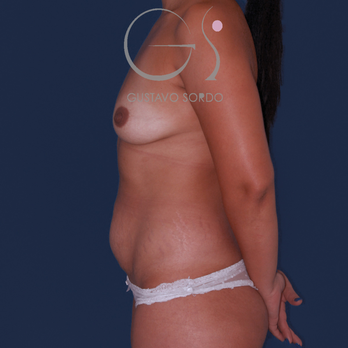 Mujer mommy makeover: antes, perfil derecho