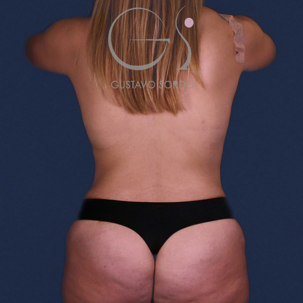 Mujer mommy makeover: después, vista de espalda