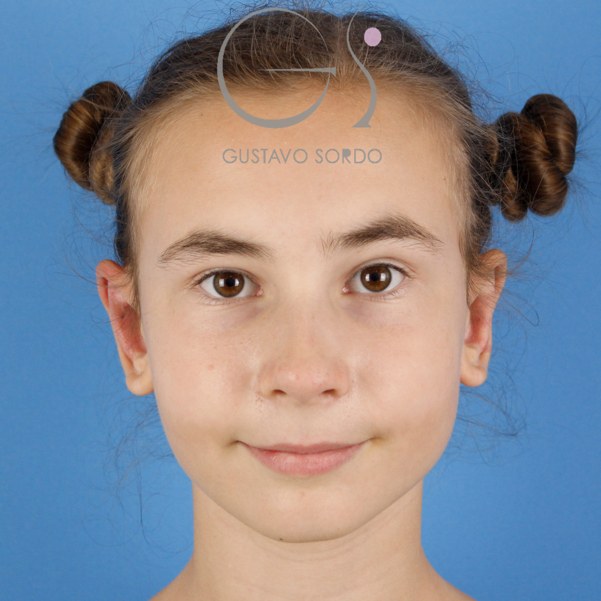 Otoplastia en una niña: después, vista frontal