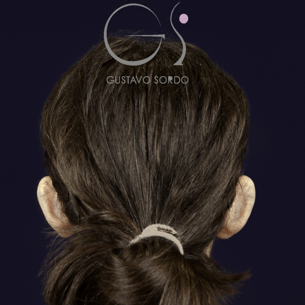 Otoplastia en orejas grandes y separadas: antes, vista de espalda