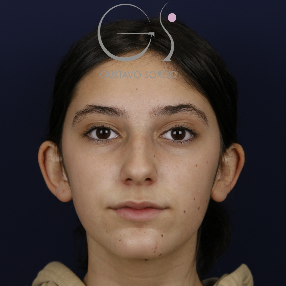 Otoplastia en orejas grandes y separadas: antes, vista frontal