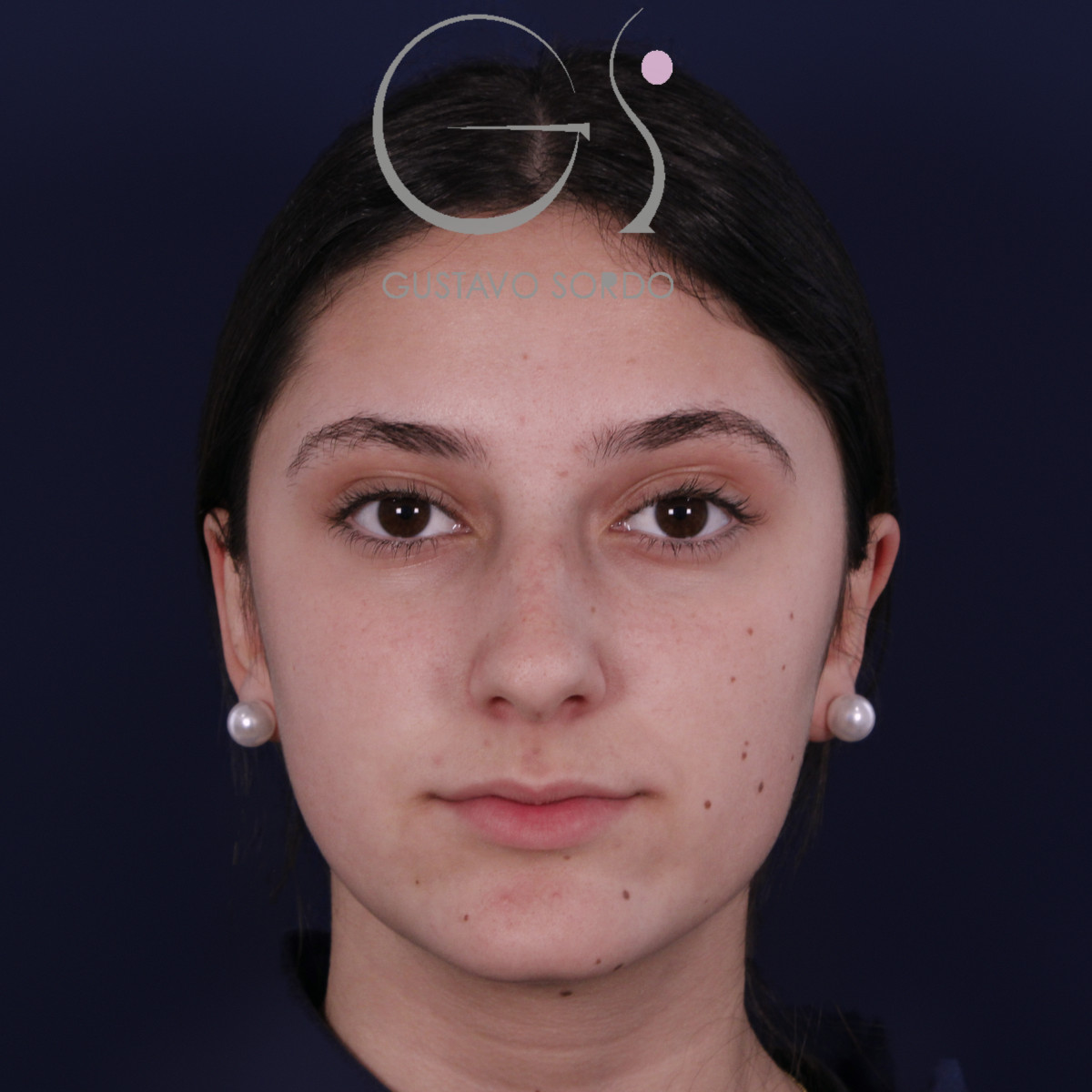 Otoplastia en orejas grandes y separadas: después, vista frontal