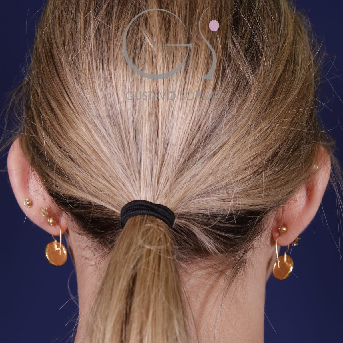 Otoplastia en mujer con orejas separadas: antes, vista de espalda