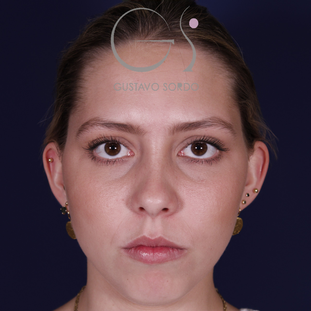 Otoplastia en mujer con orejas separadas: antes, vista frontal
