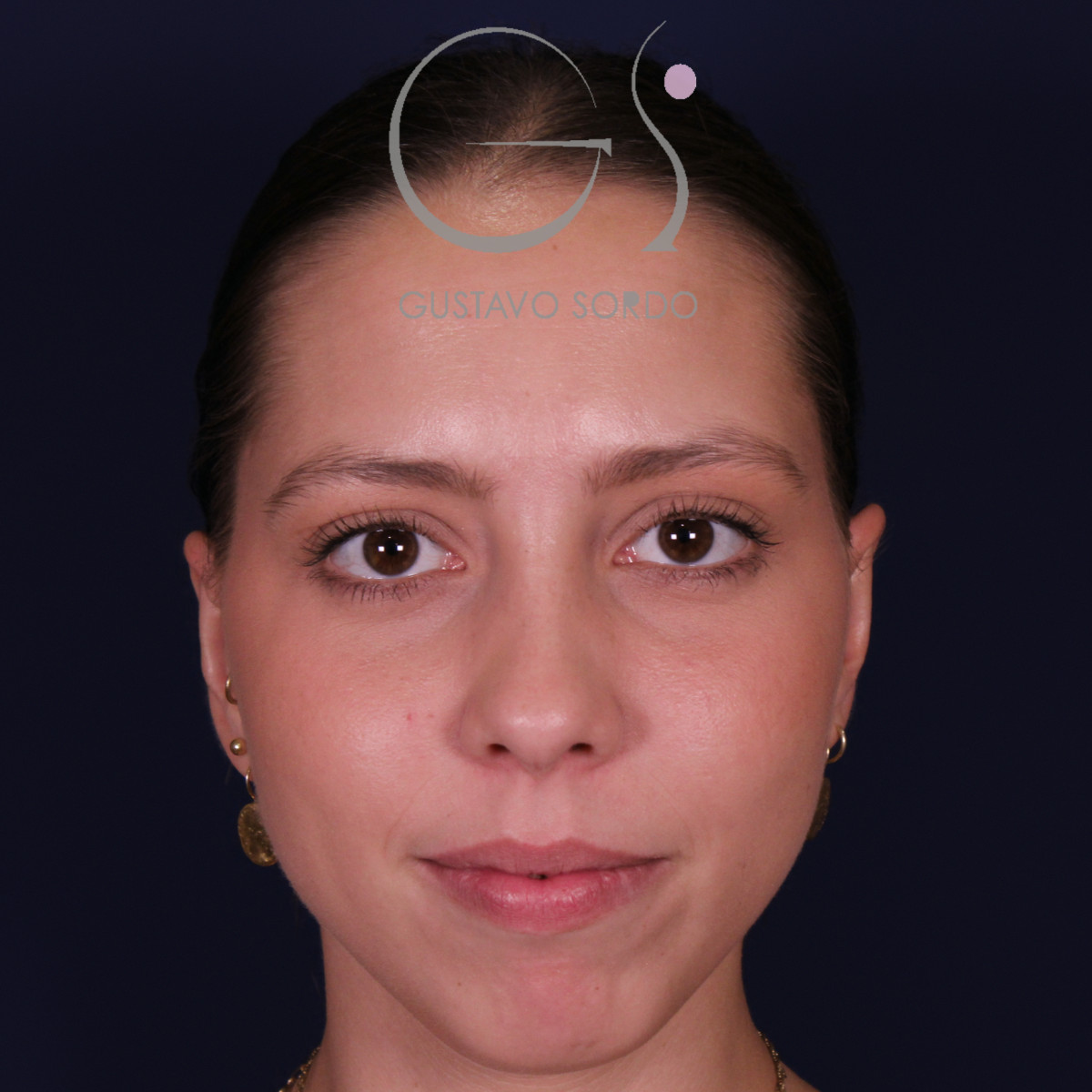 Otoplastia en mujer con orejas separadas: después, vista frontal