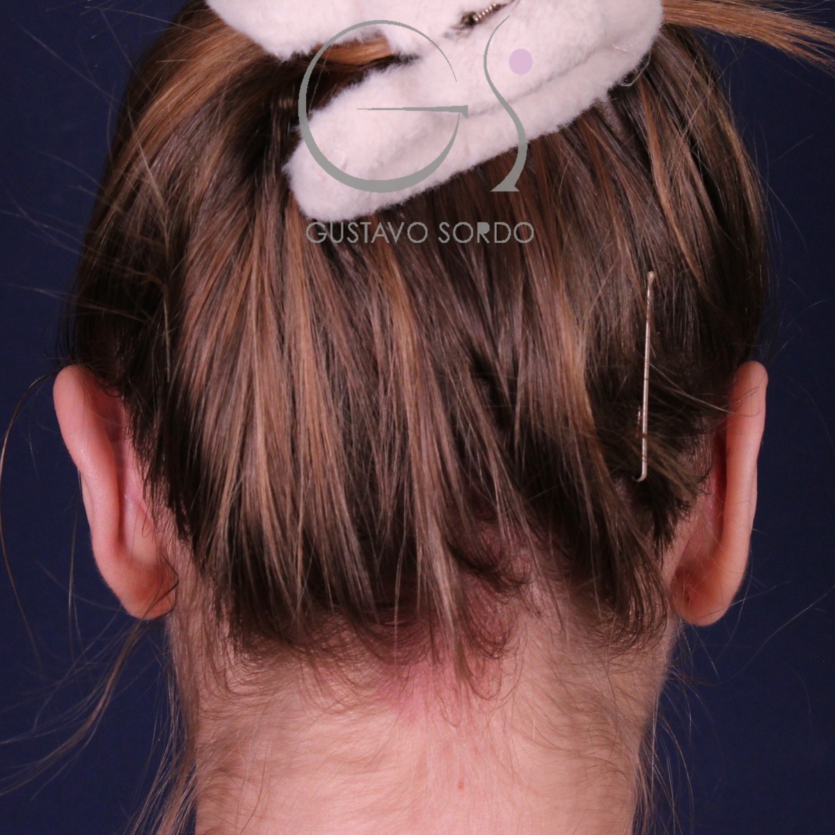 Otoplastia en orejas despegadas: después, vista de espalda