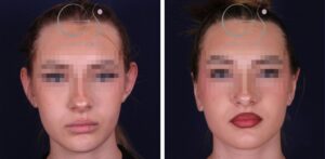 Otoplastica per orecchie sporgenti