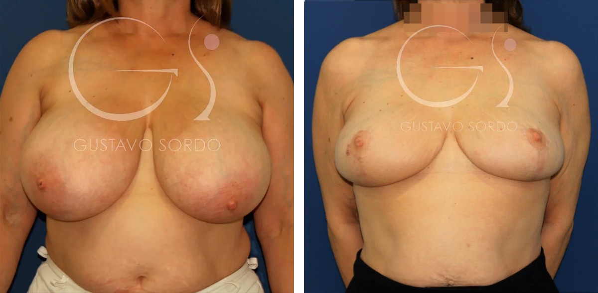 Redução mamária: antes e depois de um caso operado em Madrid.