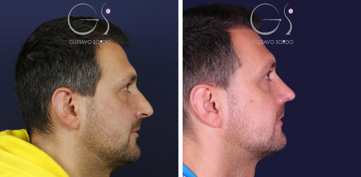 Rinoplastia en hombre con nariz desviada: antes y después