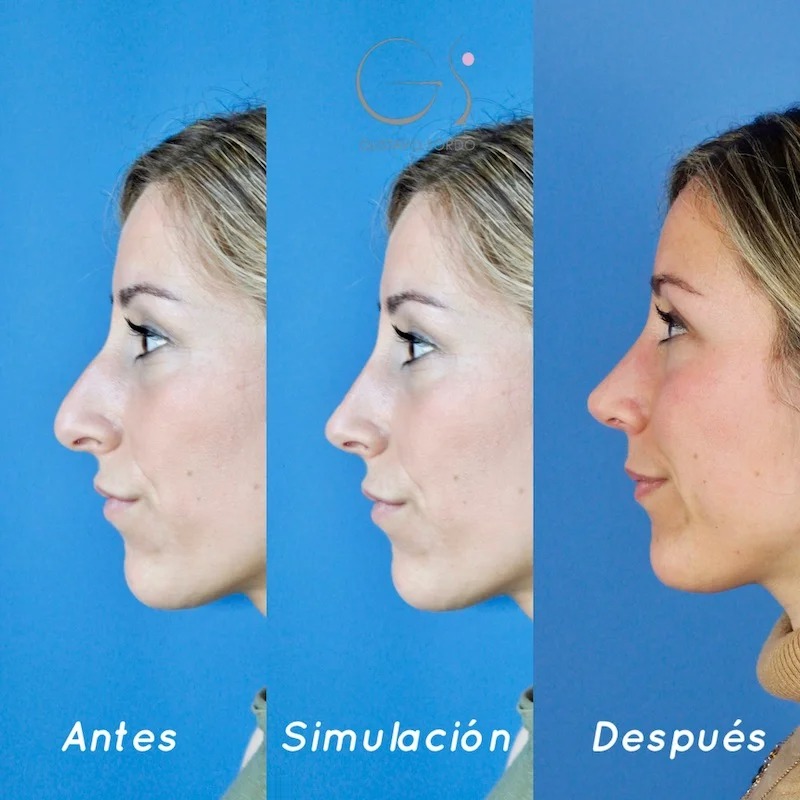 Antes, simulación y después de la rinoplastia en dorso en S y punta sin proyección, vista de perfil