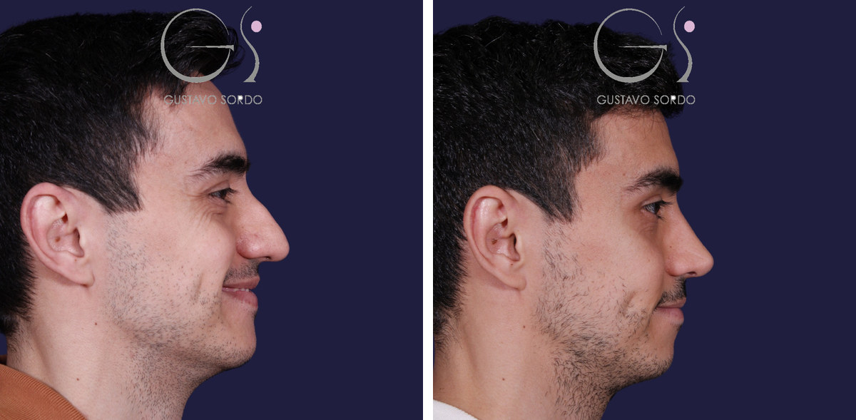 Caso de rinoplastia, antes y después (1 de 4)