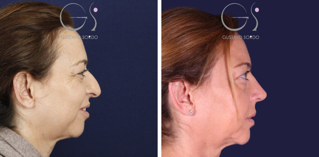 Rinoplastia — punta caída: antes y después de un caso operado en Madrid