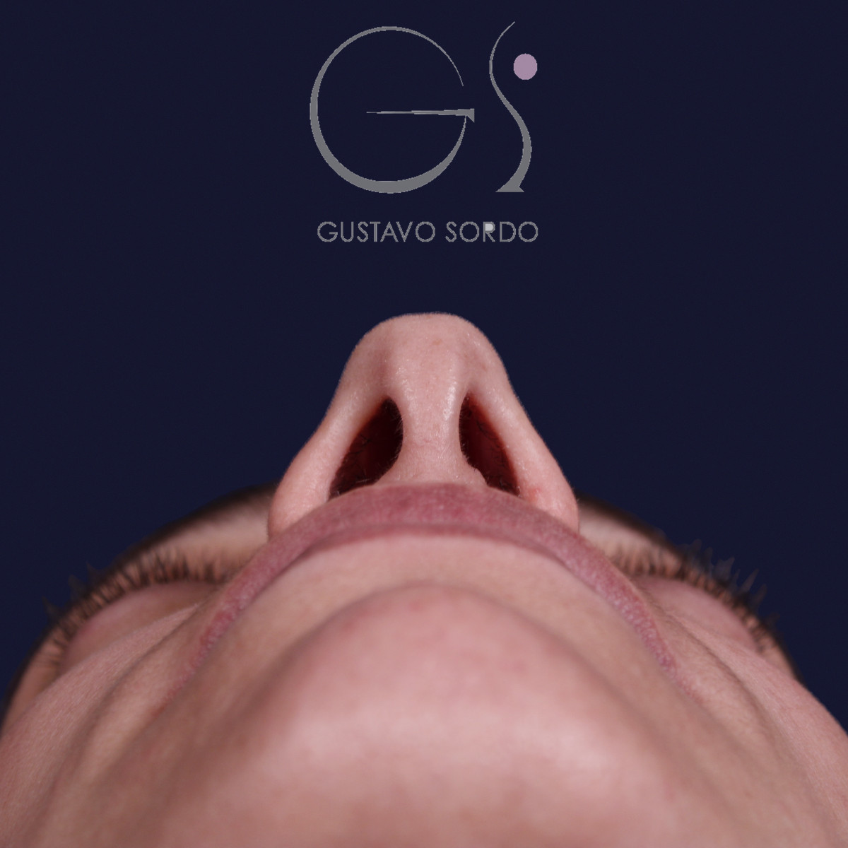 Rinoplastia con columela colgante y ala retraída, vista basal, antes de la operación