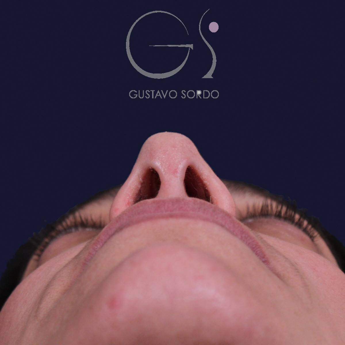 Rinoplastia con columela colgante y ala retraída, vista basal, a los dos años de la operación