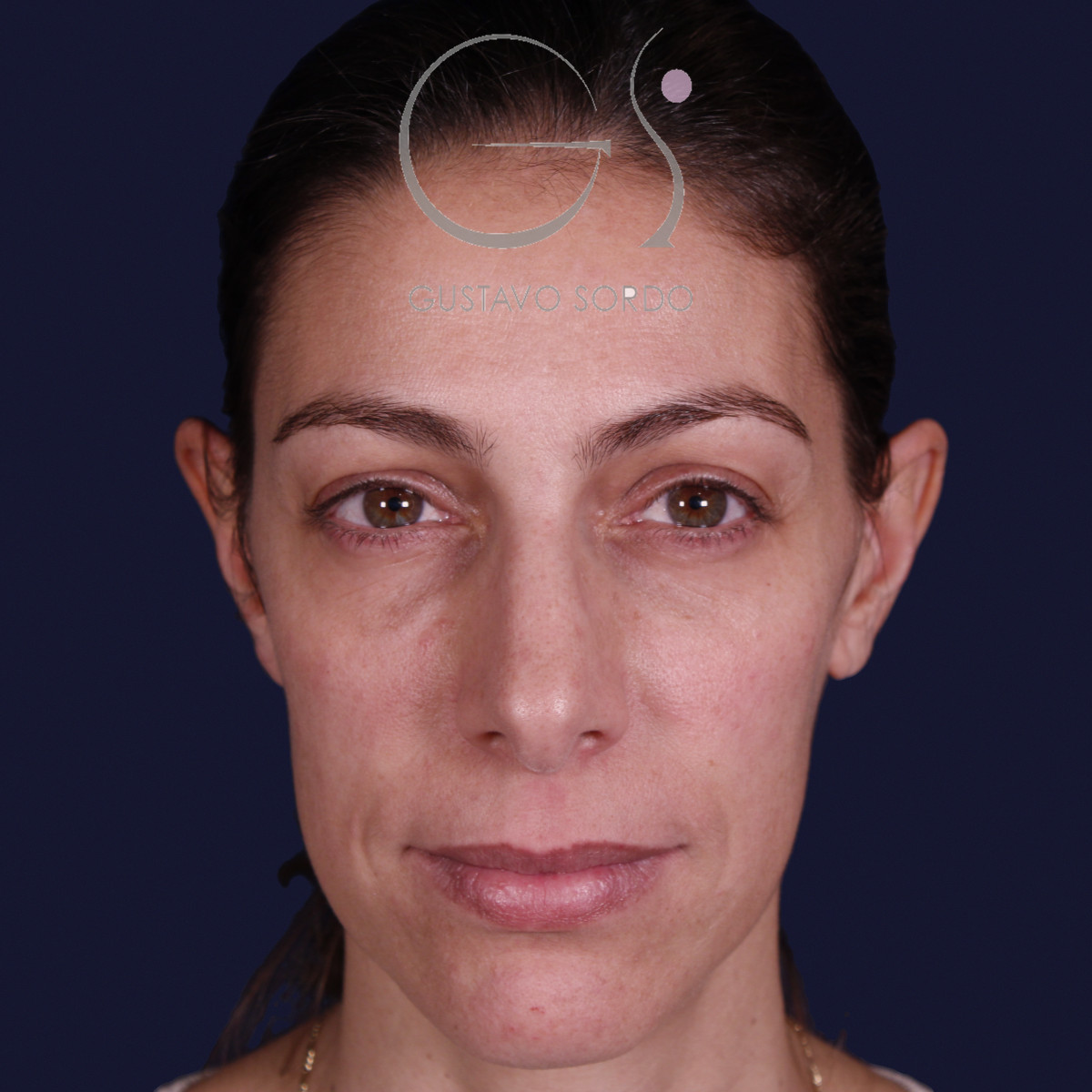 Rinoplastia con columela colgante y ala retraída, de frente, antes de la operación
