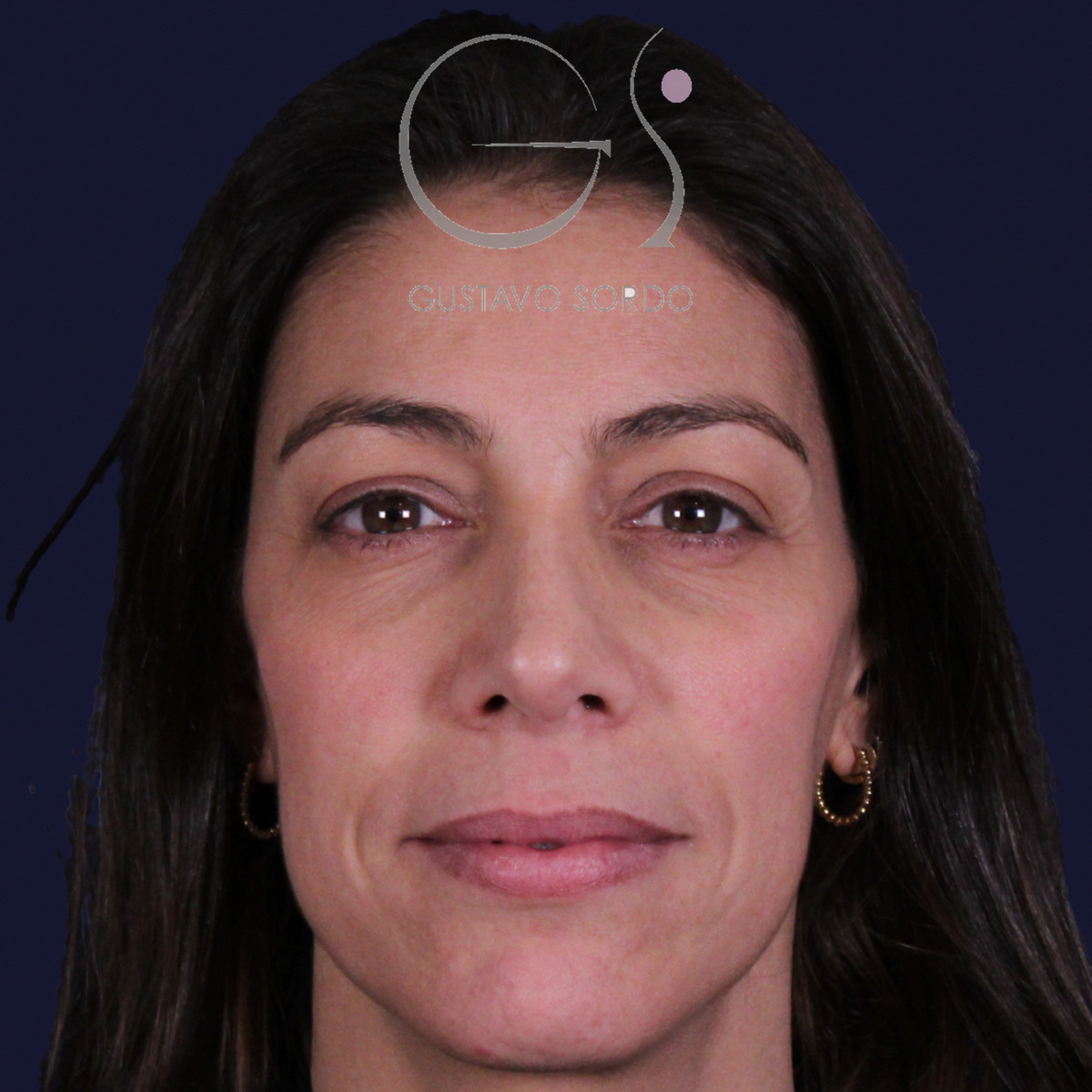 Rinoplastia con columela colgante y ala retraída, de frente, a los dos años de la operación