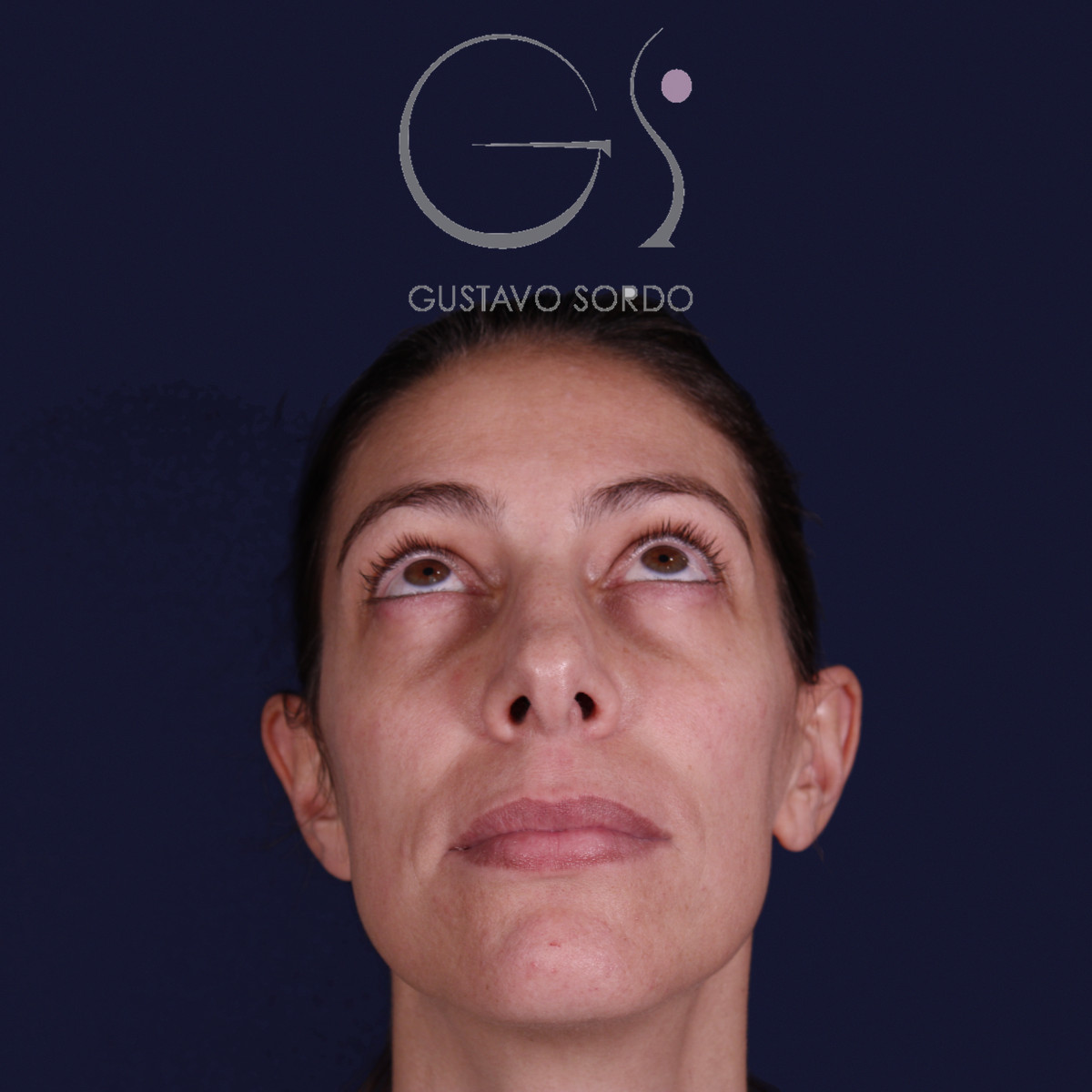 Rinoplastia con columela colgante y ala retraída, con el mentón arriba, antes de la operación