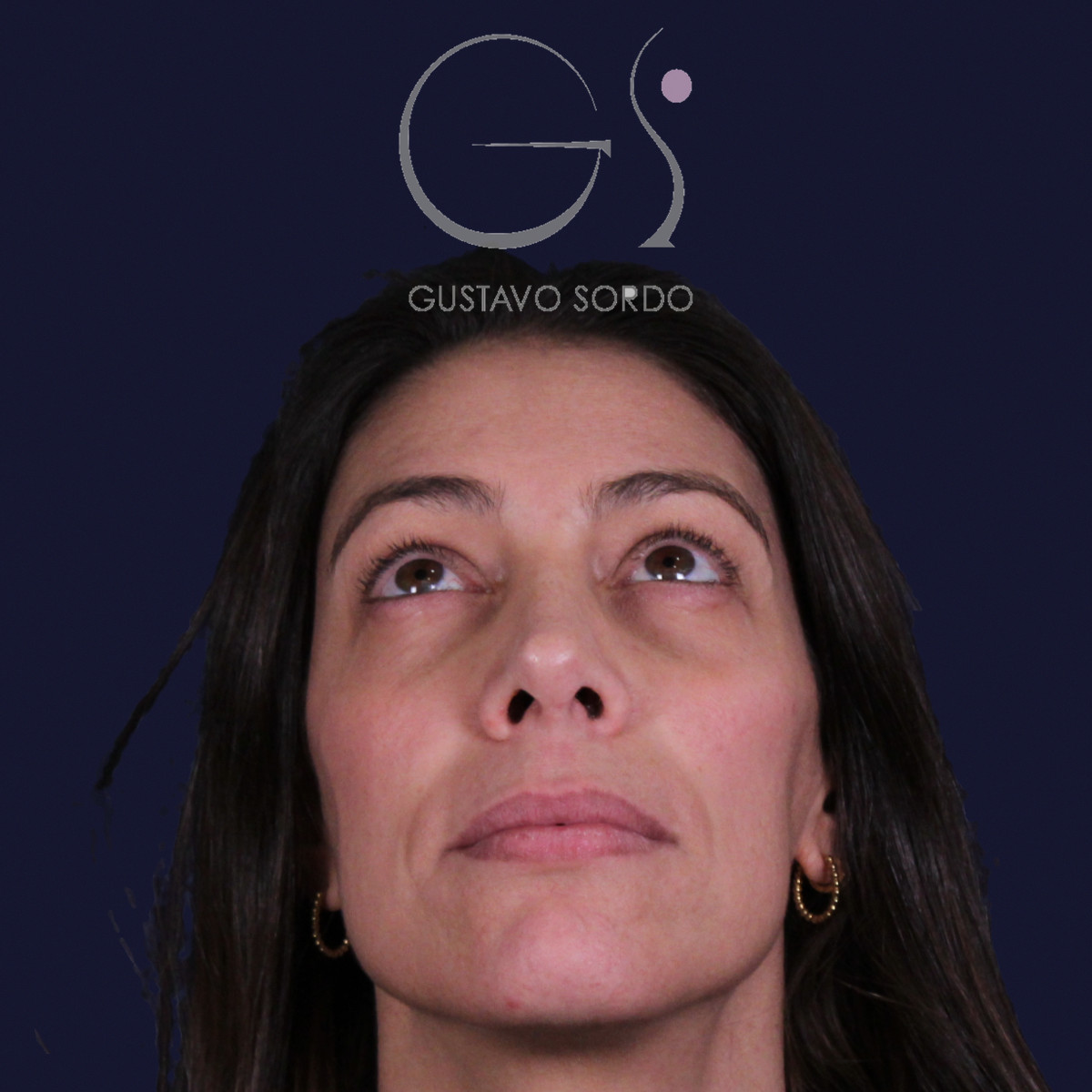 Rinoplastia con columela colgante y ala retraída, con el mentón arriba, a los dos años de la operación