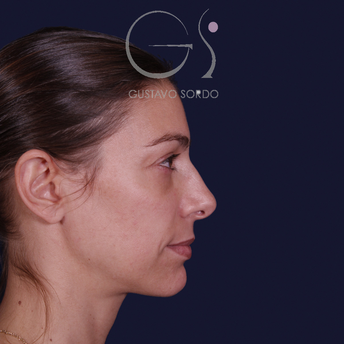 Rinoplastia con columela colgante y ala retraída, perfil derecho, antes de la operación