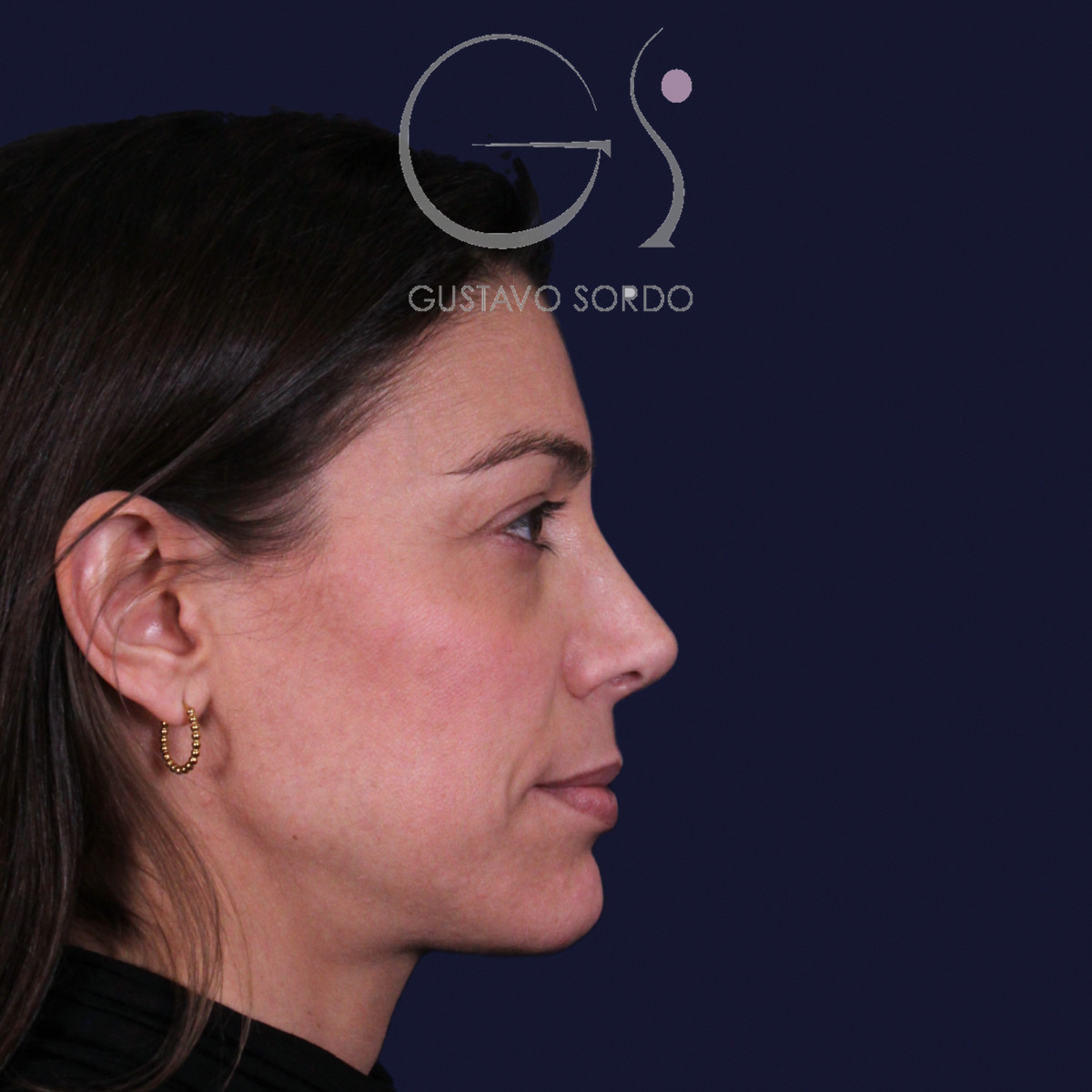 Rinoplastia con columela colgante y ala retraída, perfil derecho, a los dos años de la operación