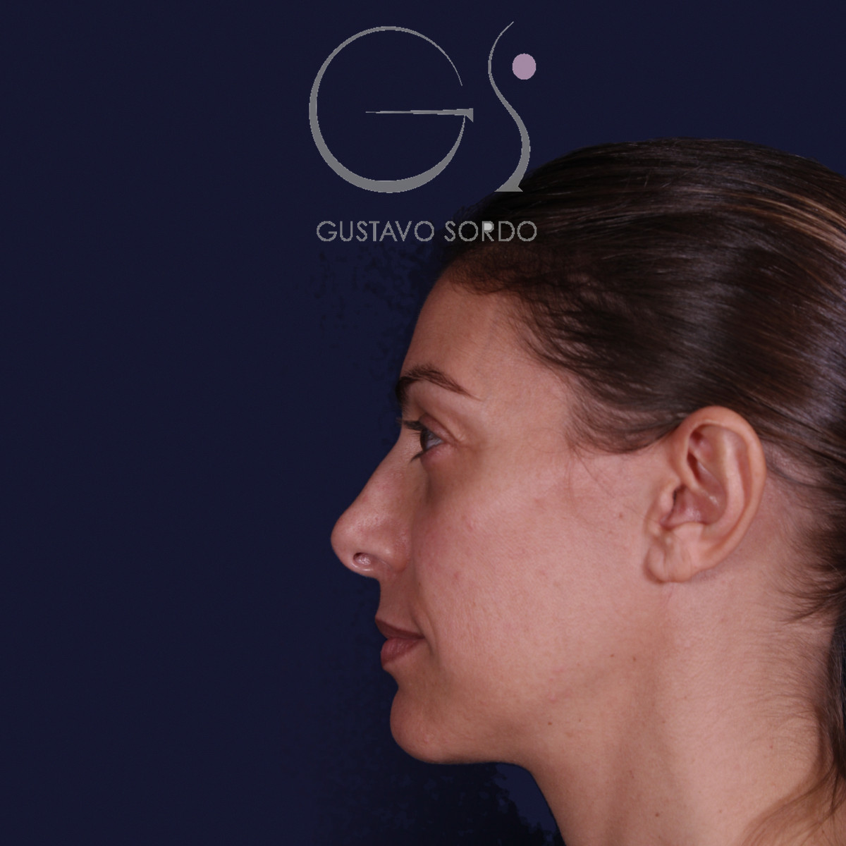 Rinoplastia con columela colgante y ala retraída, perfil izquierdo, antes de la operación