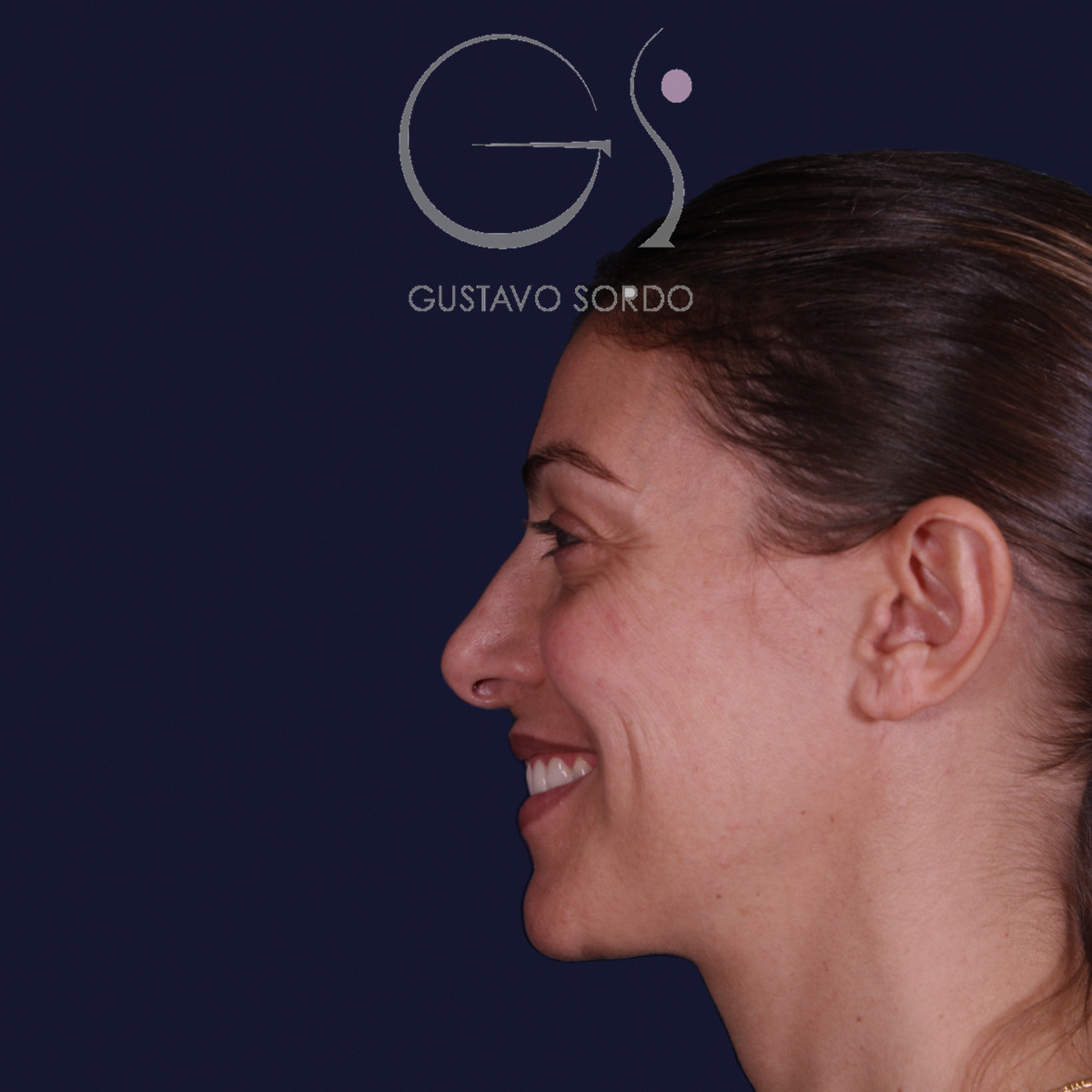 Rinoplastia con columela colgante y ala retraída, perfil izquierdo sonriendo, antes de la operación