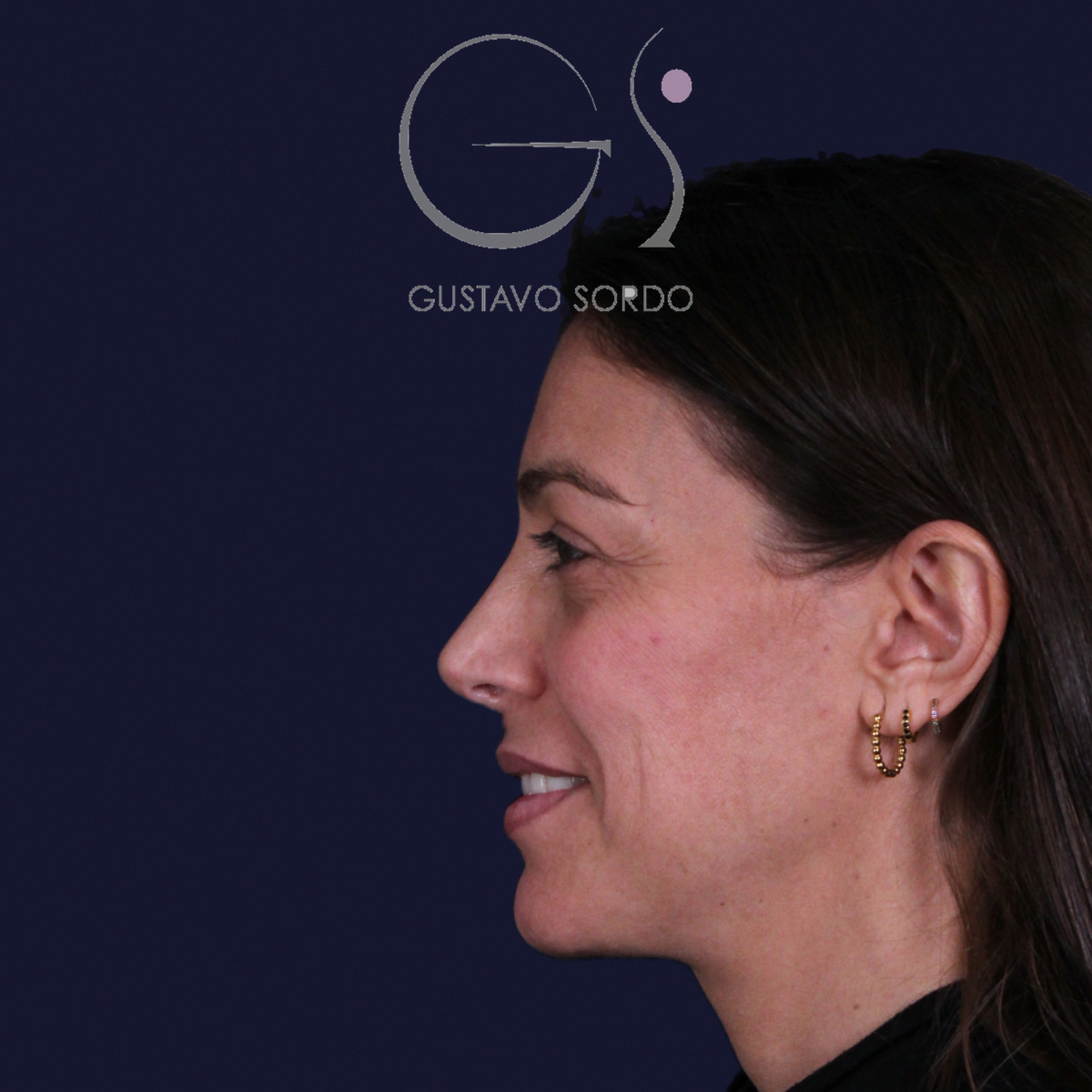 Rinoplastia con columela colgante y ala retraída, perfil izquierdo sonriendo, a los dos años de la operación