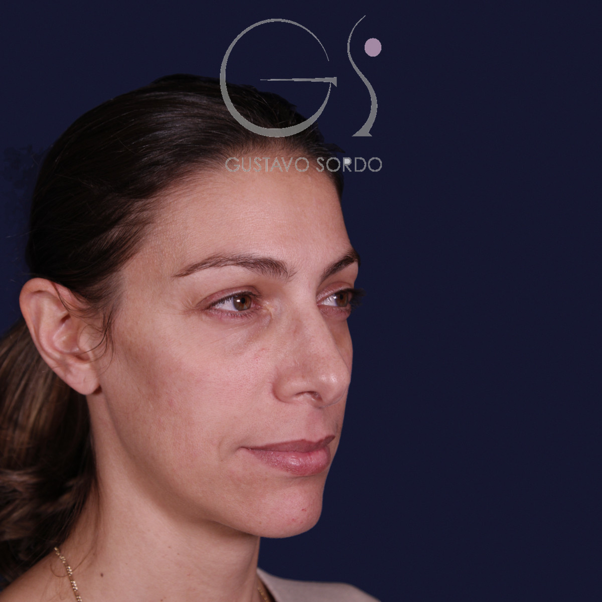 Rinoplastia con columela colgante y ala retraída, semiperfil derecho, antes de la operación